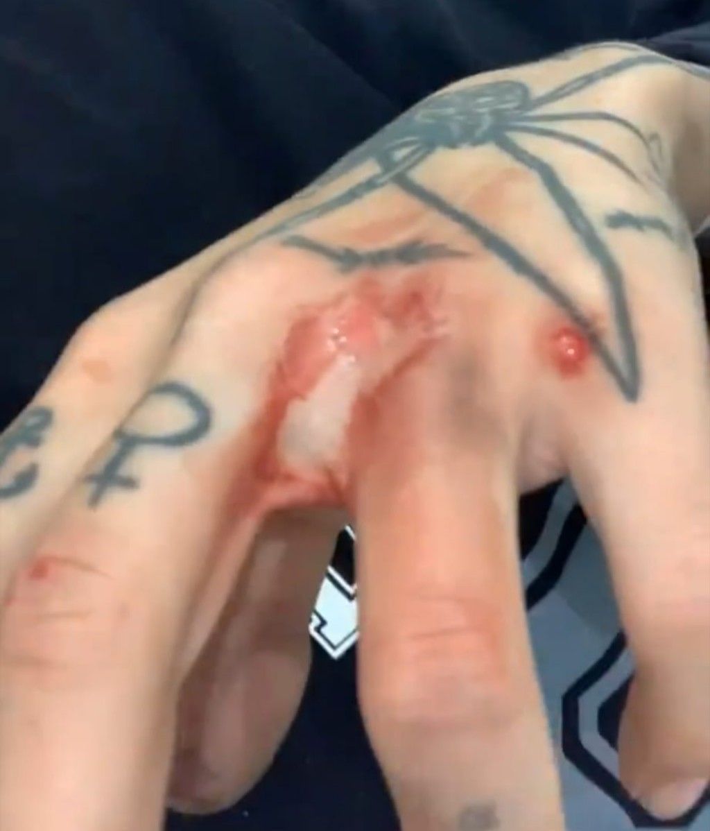 Valeria Quer con el dedo roto