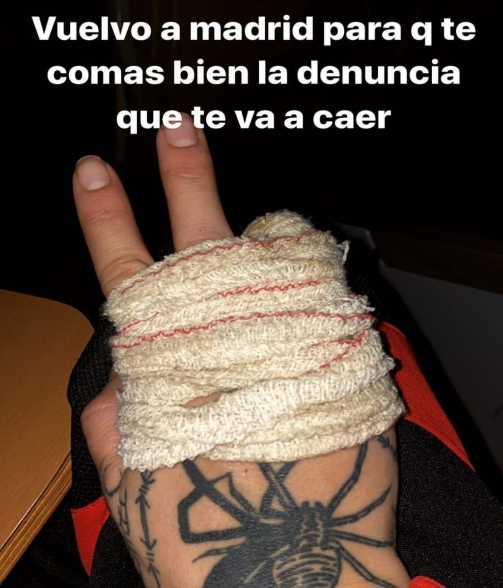 Valeria Quer con la mano vendada