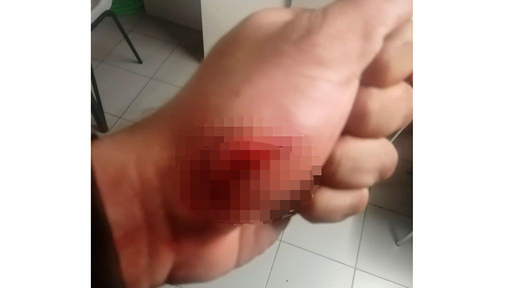 Mordedura mano