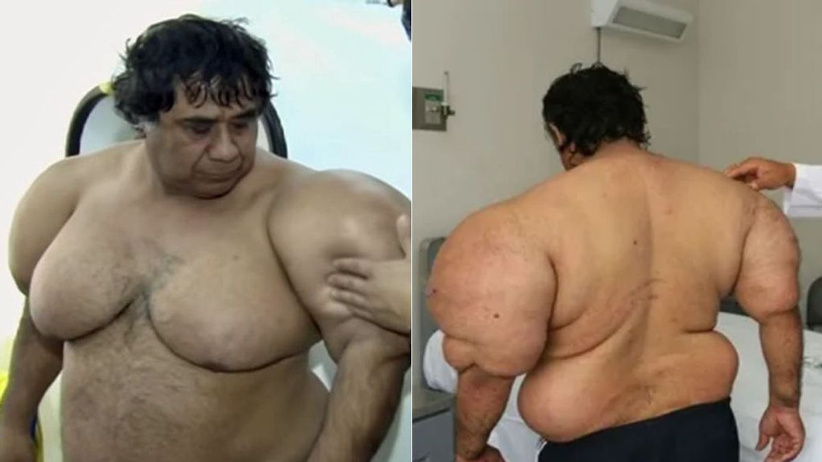El cuerpo totalmente deformado de un buzo que ascendió 35 metros en un minuto sin esperar a la descompresión El cuerpo totalmente deformado de un buzo que ascendió 35 metros en un minuto sin esperar a la descompresión