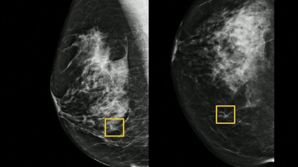 Un sistema de inteligencia artificial podría mejorar la detección del cáncer de mama Un sistema de inteligencia artificial podría mejorar la detección del cáncer de mama
