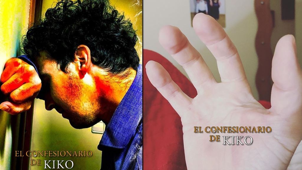 Javier Palomares perdió su dedo anular en un accidente