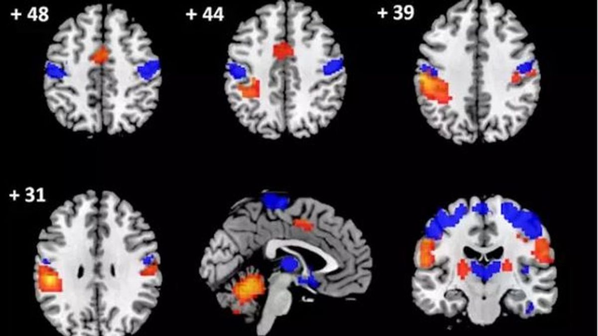 Una de las principales causas de daños cerebrales son las hernias cervicales Una de las principales causas de daños cerebrales son las hernias cervicales