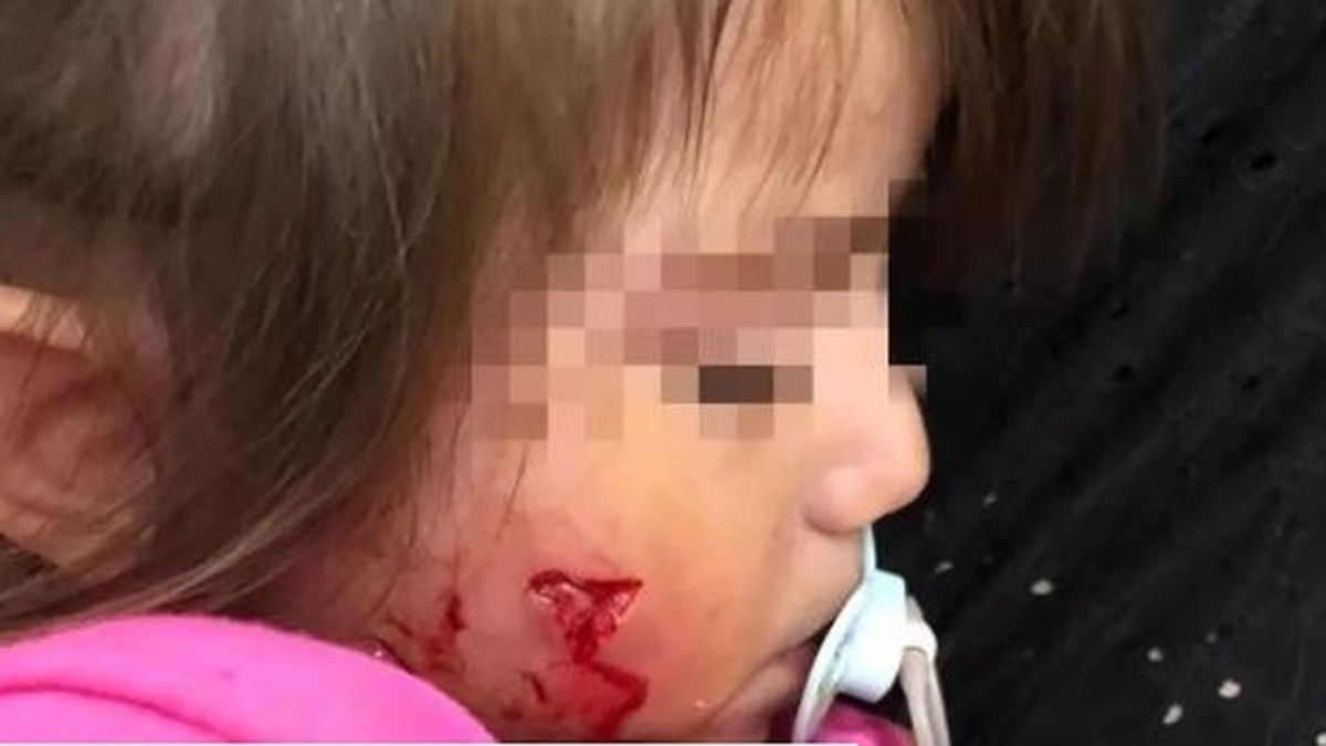 Un perro peligroso muerde a una niña de 2 años, le arrancó parte del cachete