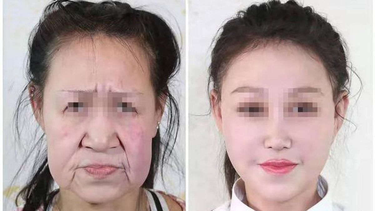 Una adolescente china, con apariencia de anciana, se somete a una cirugía para conseguir un nuevo rostro