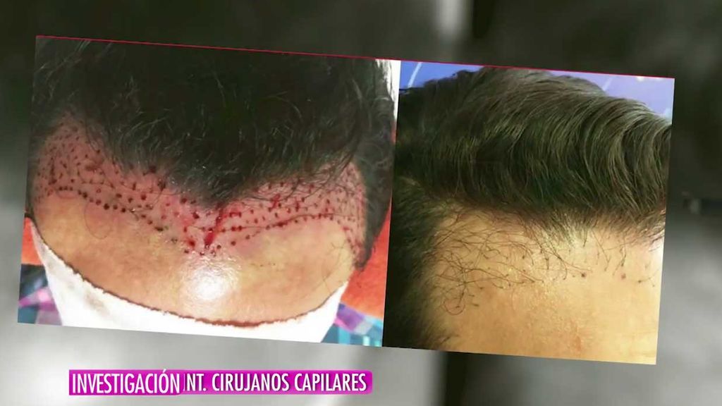 Investigación: El peligro de los trasplantes de pelo en Turquía