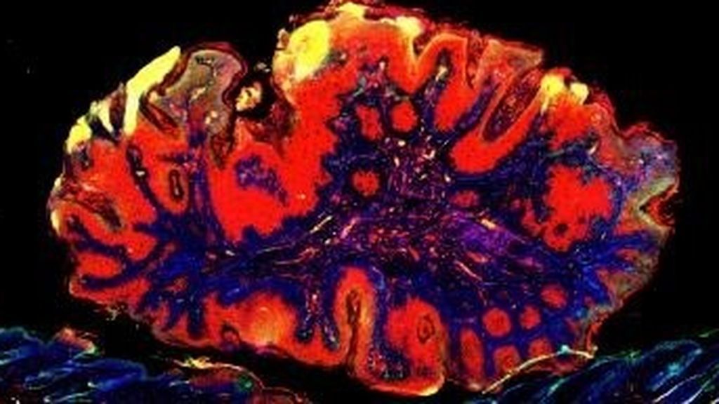 Identifican ocho nuevas regiones del genoma que aumenta el riesgo de cáncer de piel Identifican ocho nuevas regiones del genoma que aumenta el riesgo de cáncer de piel