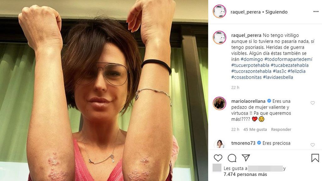 Raquel Perera confiesa que pacede psoriasis