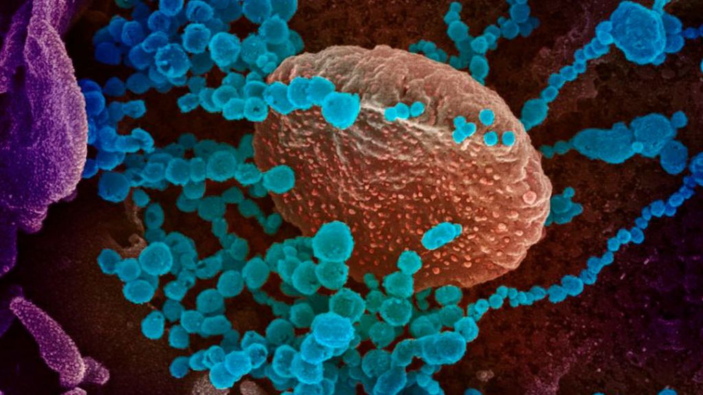 Coronavirus, en azul, entre células de un paciente de Estados Unidos