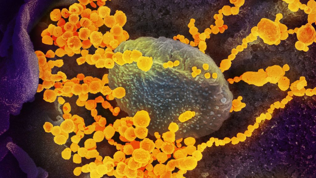Imagen del SARS-CoV-2, el virus que causa el brote del coronavirus COVID-19, en un paciente de EEUU