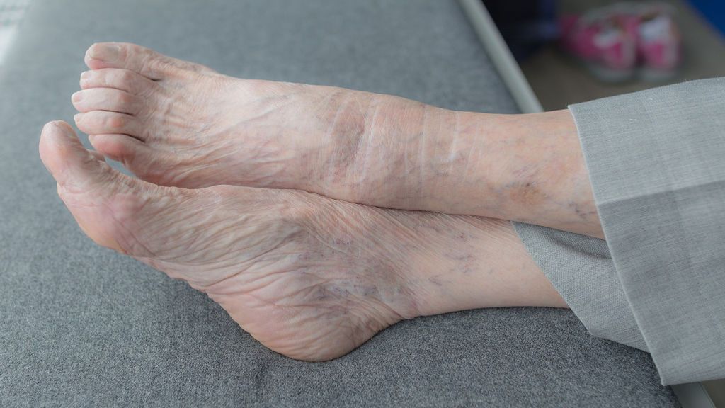 ¿Por qué salen las varices y cómo prevenirlas?