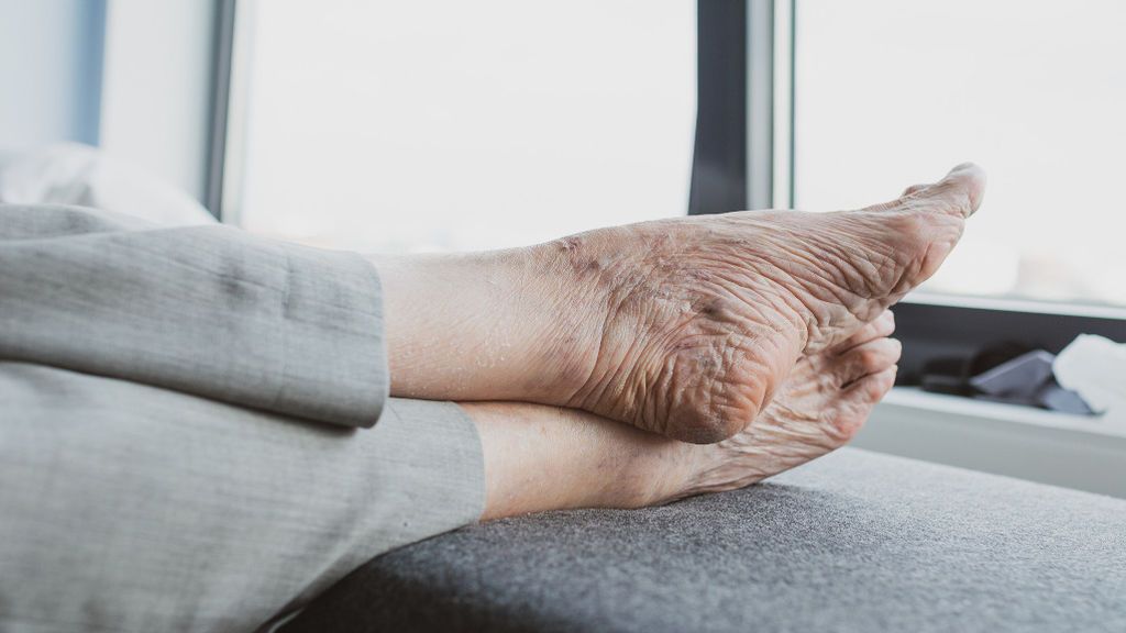 ¿Qué tipo de varices padezco y cómo debo tratarlas?