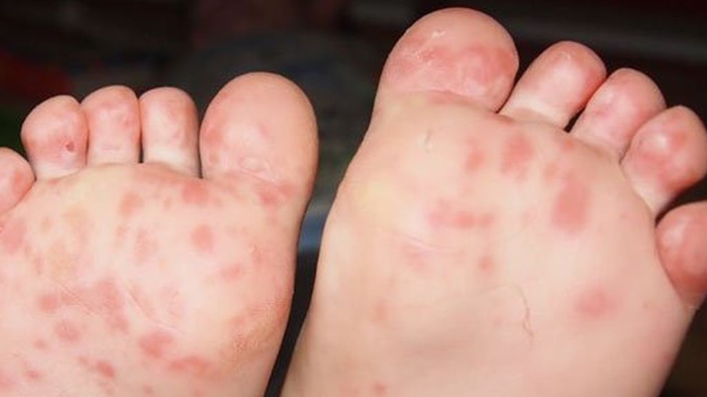 El virus suele aparecer en la zona de los pies, la boca, manos y nalgas.