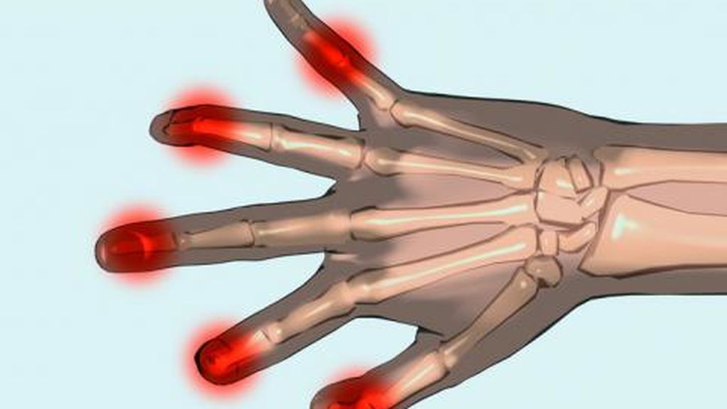 Clínicas Cres: medicina Regenerativa, el nuevo tratamiento para la artrosis  de las manos