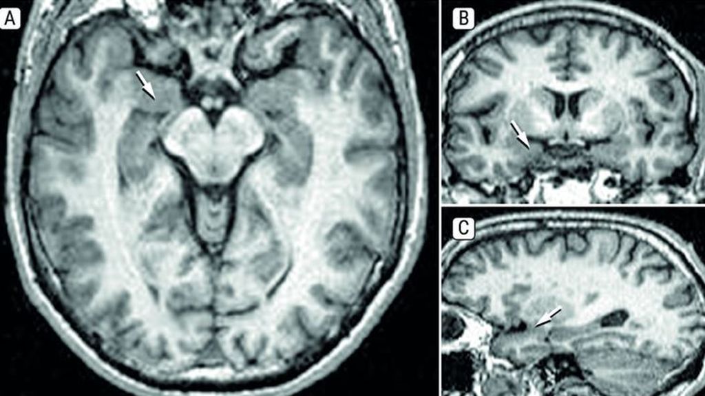 Cortes del cerebro humano