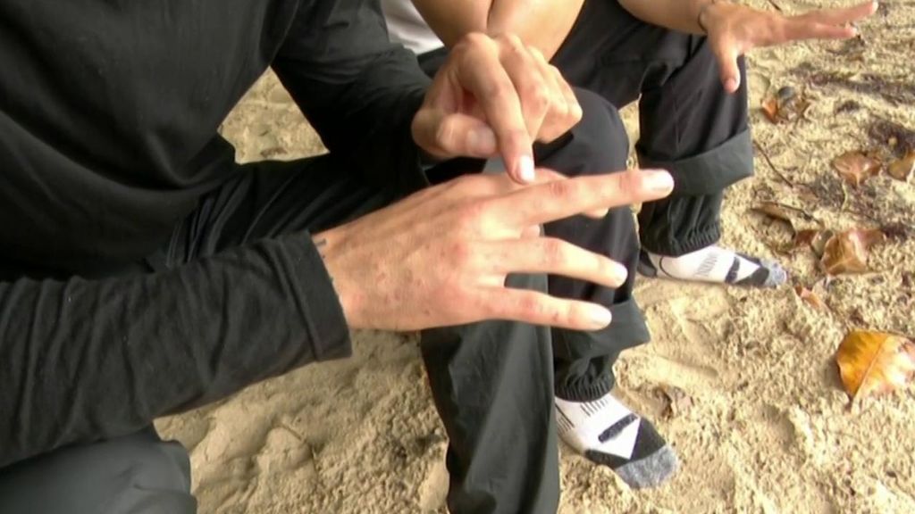 La mano de Barranco llena de picaduras