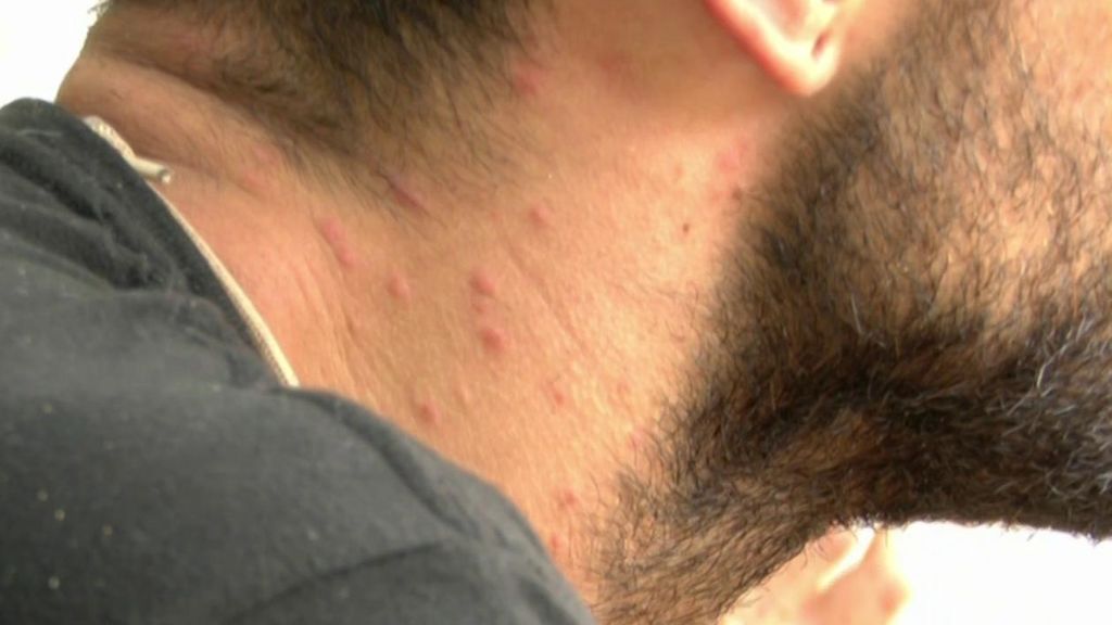 El cuello de Barranco lleno de picaduras