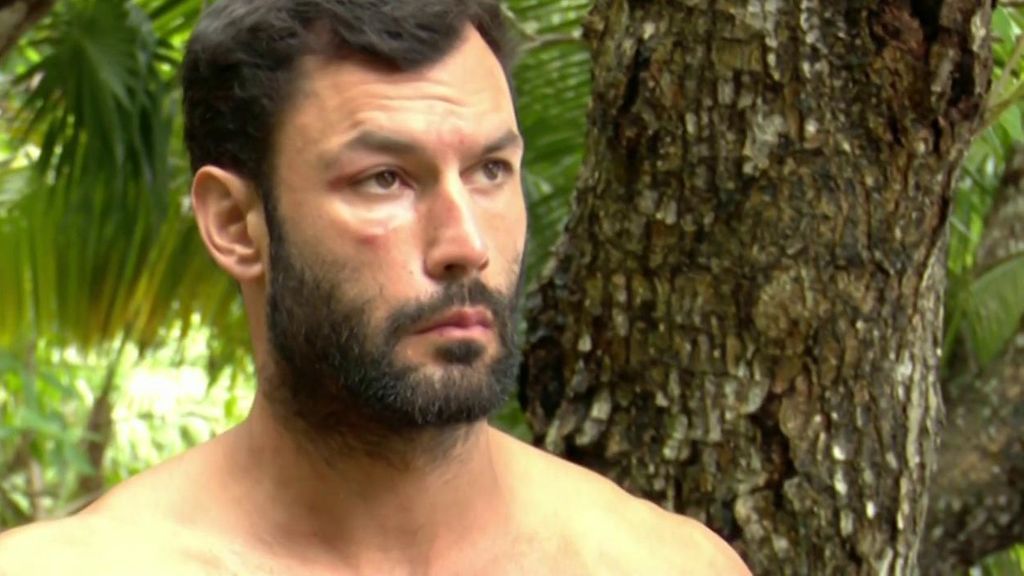 Jorge con la cara llena de picaduras de mosquito