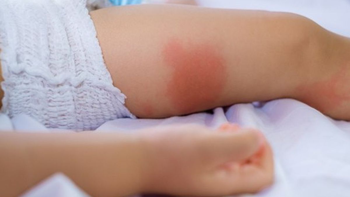 La piel atópica es muy común en bebés.