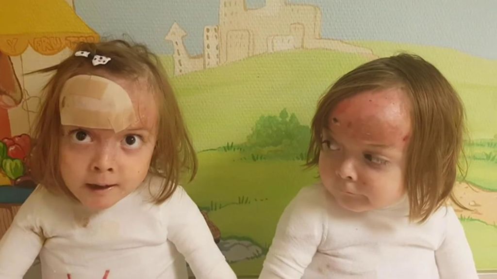 El mensaje de dos niñas que llevan 4 meses en el hospital: "Nosotras no nos quejamos. Quédate en casa"