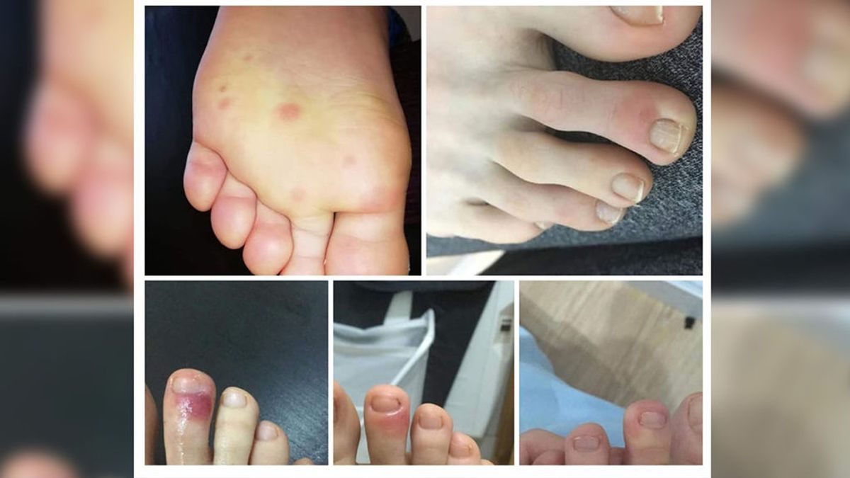 Erupciones en los pies, primera pista para detectar COVID-19 en adolescentes Erupciones en los pies, primera pista para detectar COVID-19 en adolescentes