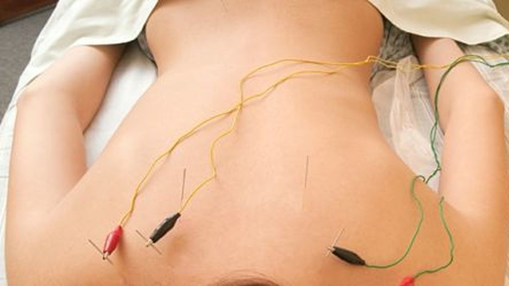 Electroacupuntura.