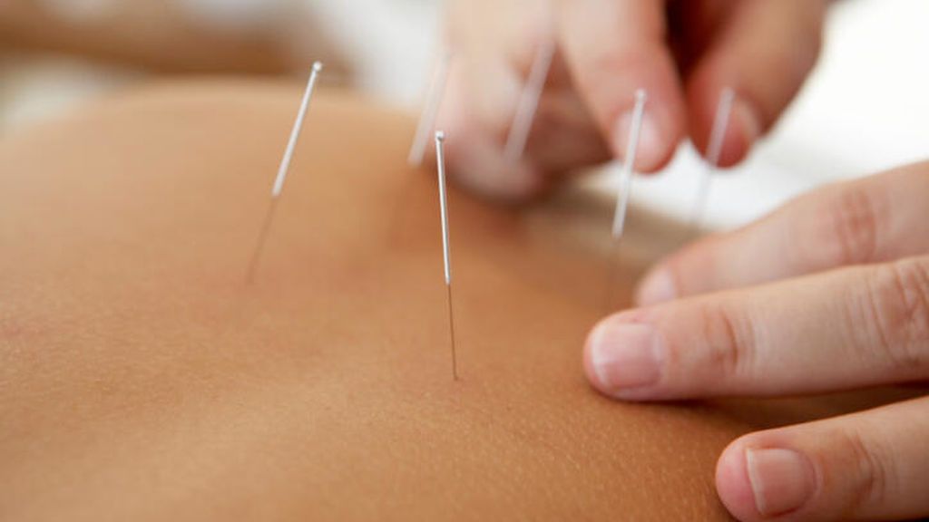 Acupuntura.