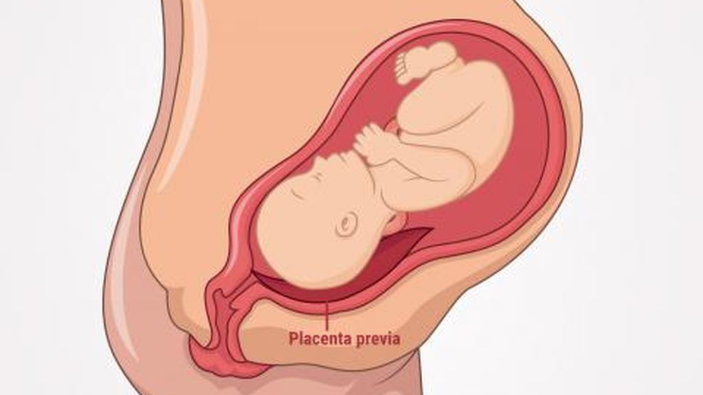 Qué es la placenta previa o baja.