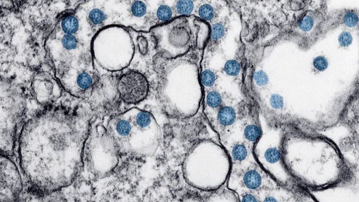 La "misteriosa" proliferación de trombos en los enfermos de COVID-19 La "misteriosa" proliferación de trombos en los enfermos de COVID-19