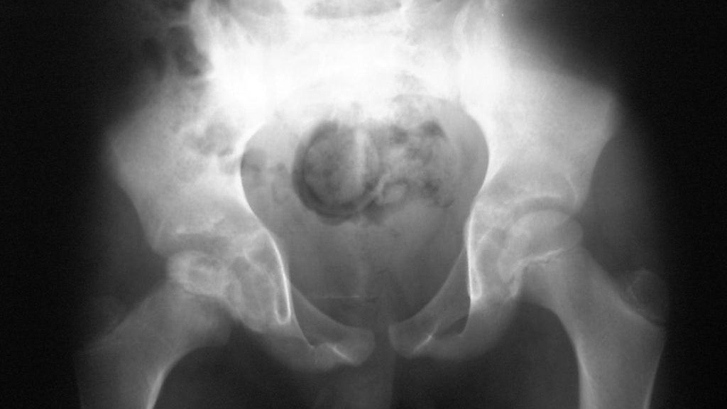 ¿Puede dejar secuelas la enfermedad de Perthes?