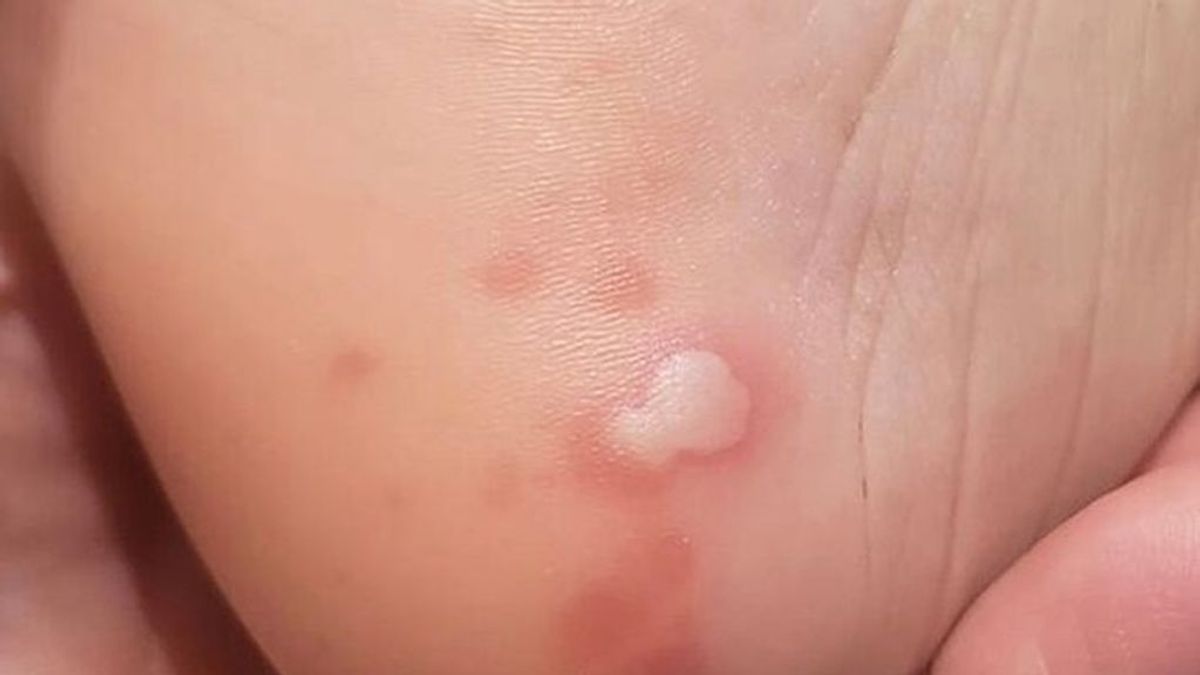 Sabañones, necrosis, erupciones como las de la varicela:  los síntomas cutáneos por COVID- 19