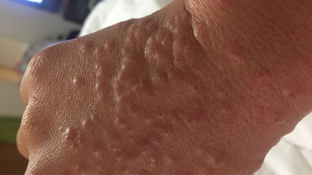 varicela3