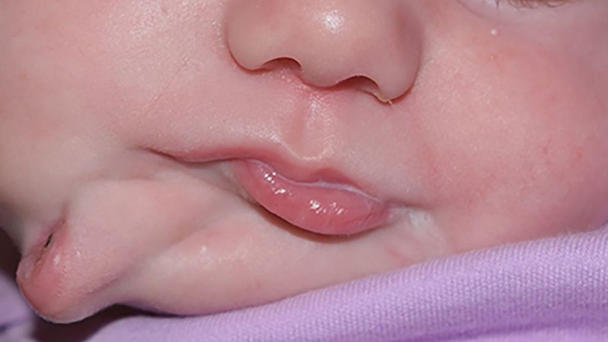 Una bebé nace con dos bocas: la extraña condición que investigan los médicos