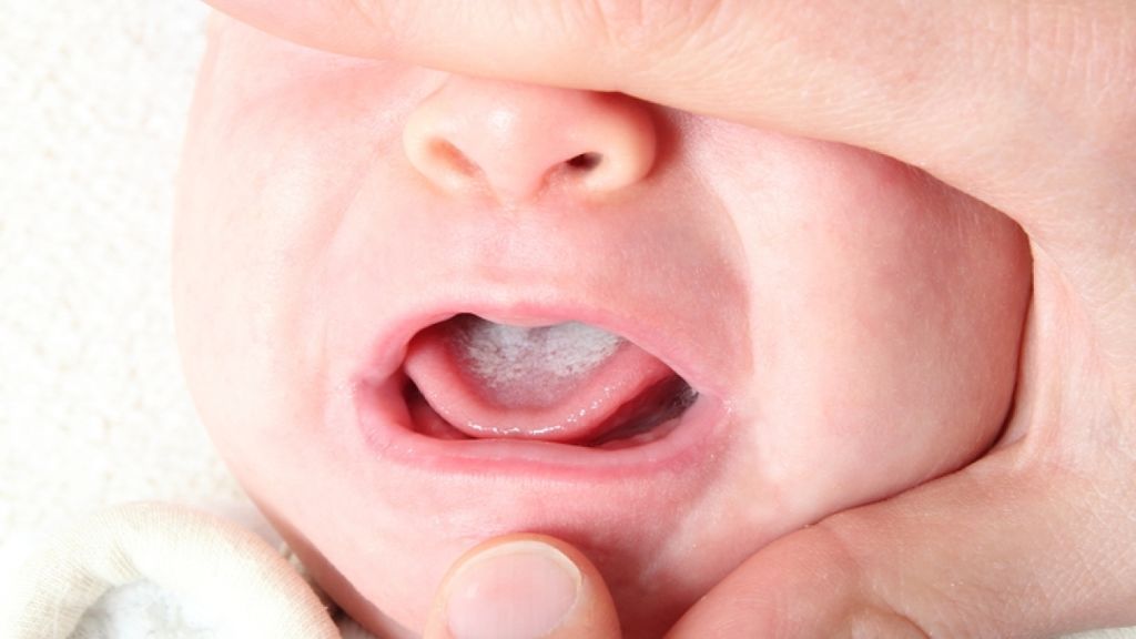 El bebé se podrá contagiar de candidiasis a través del pezón de su madre.