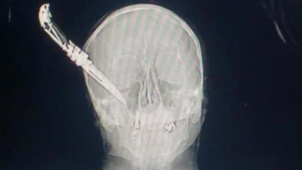 La radiografía de una agresión: el navajazo en la cabeza a un hombre que evitó un robo en Getxo La radiografía de una agresión: el navajazo en la cabeza a un hombre que evitó un robo en Getxo
