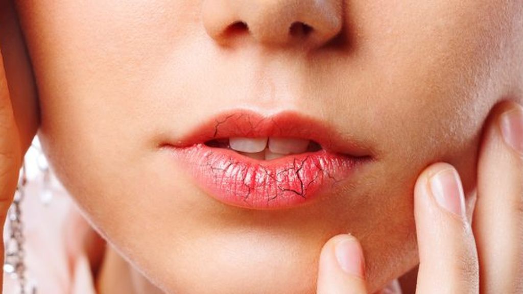 La sobreexposición al frío o al calor hará que los labios se sequen.