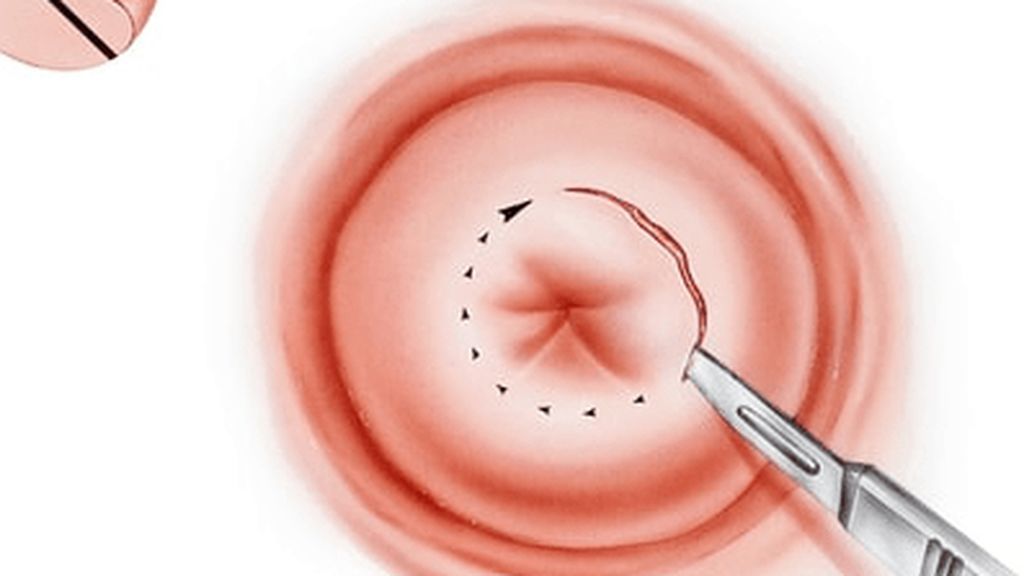 La conización cervical será totalmente indolora.