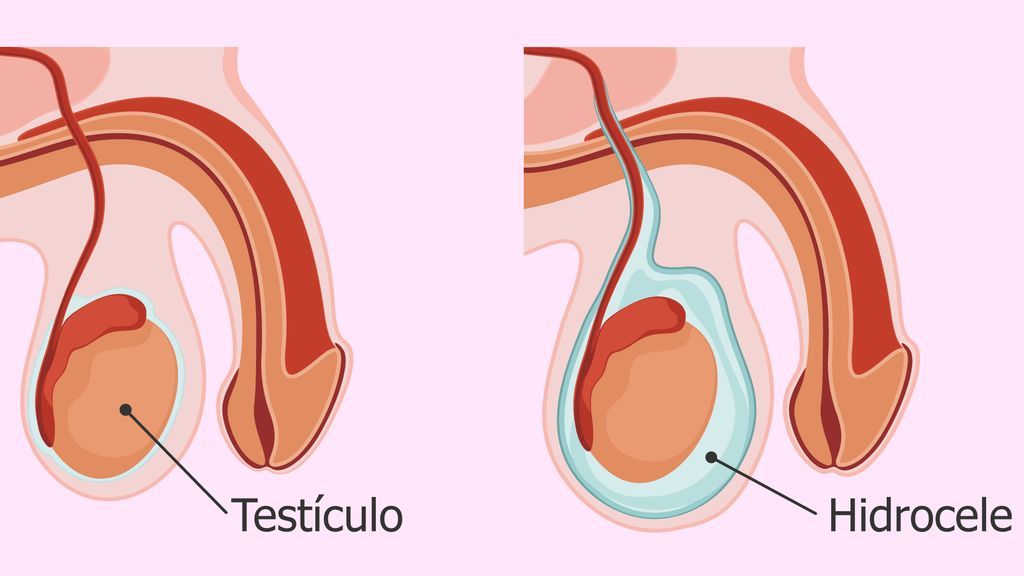 La hidrocele es una afección que suele afectar a los recién nacidos.