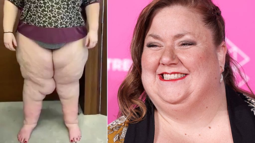 El lipedema de Itziar Castro