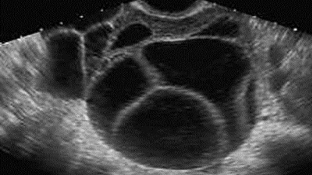 Alrededor de uno de cada mil embarazos se diagnostica como embarazo molar.