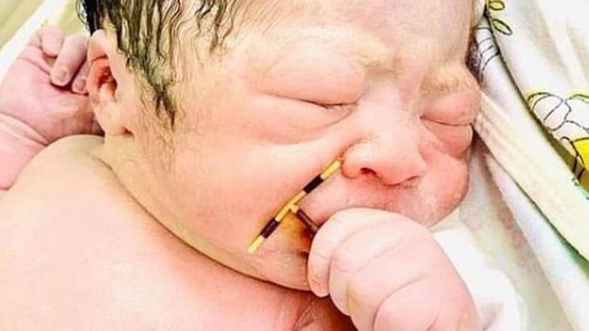 Un bebé nace agarrado al DIU que su madre tenía implantado para no quedarse embarazada