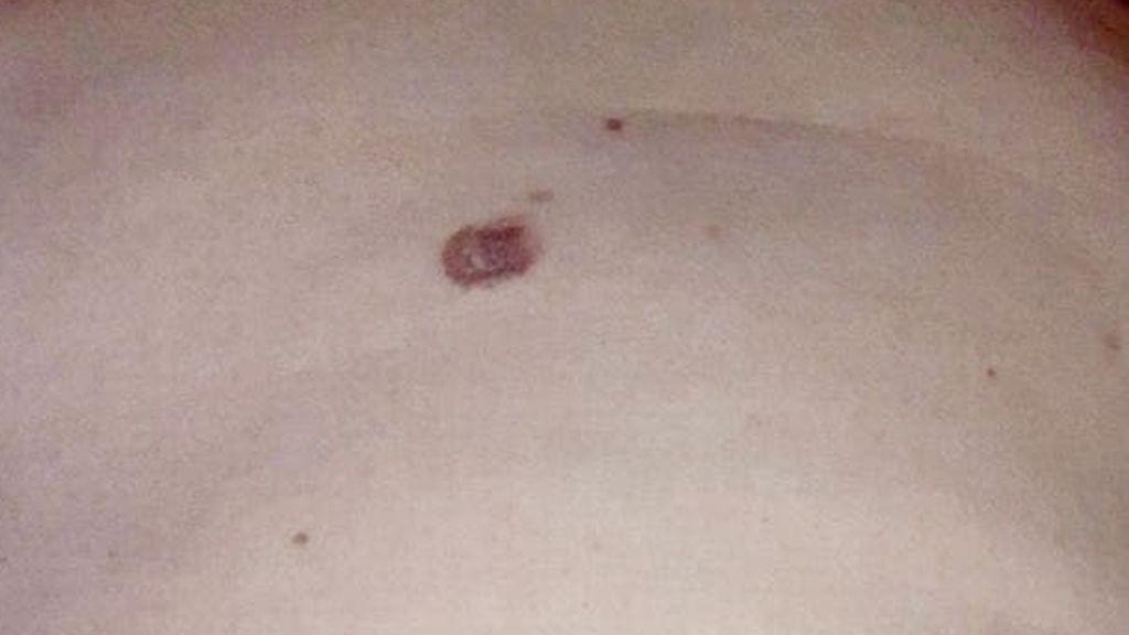 Imagen del melanoma de Sharon