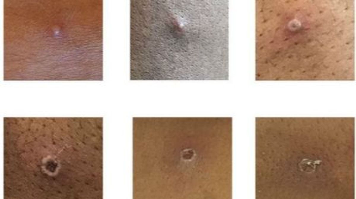 Pústulas de la Viruela del mono Pústulas de la Viruela del mono