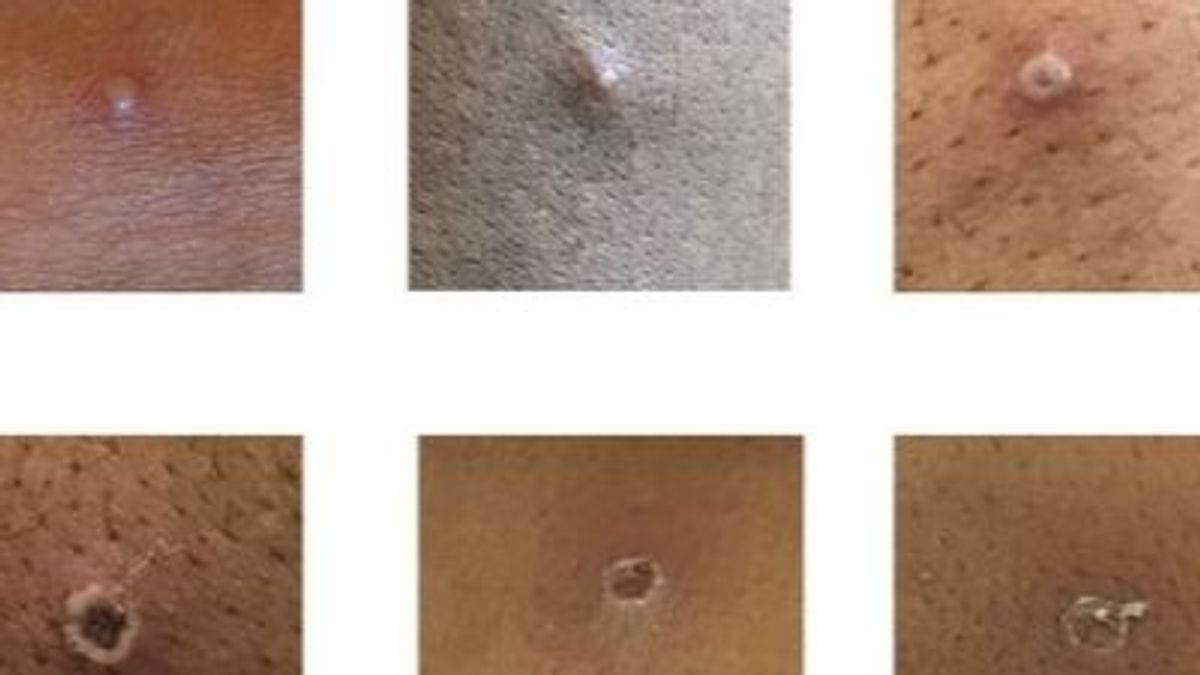El productor de la vacuna contra la viruela del mono asegura que "hay suficientes suministros disponibles" El productor de la vacuna contra la viruela del mono asegura que "hay suficientes suministros disponibles"