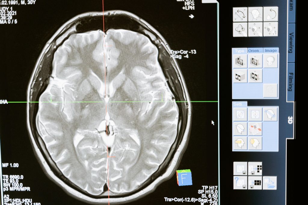 La forma del cerebro predice el Alzheimer