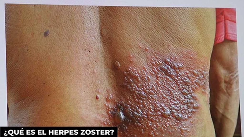 A quién afecta el virus que provoca el herpes zóster