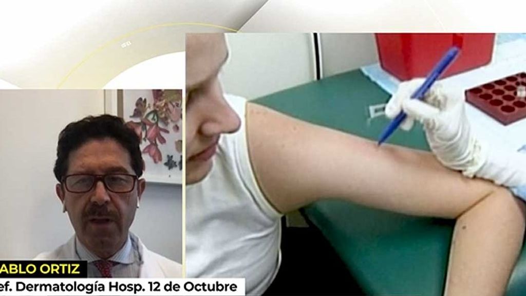 Jefe de Dermatología del Hospital 12 de Octubre tranquiliza sobre la vacuna del mono: “La tormenta está escampando”