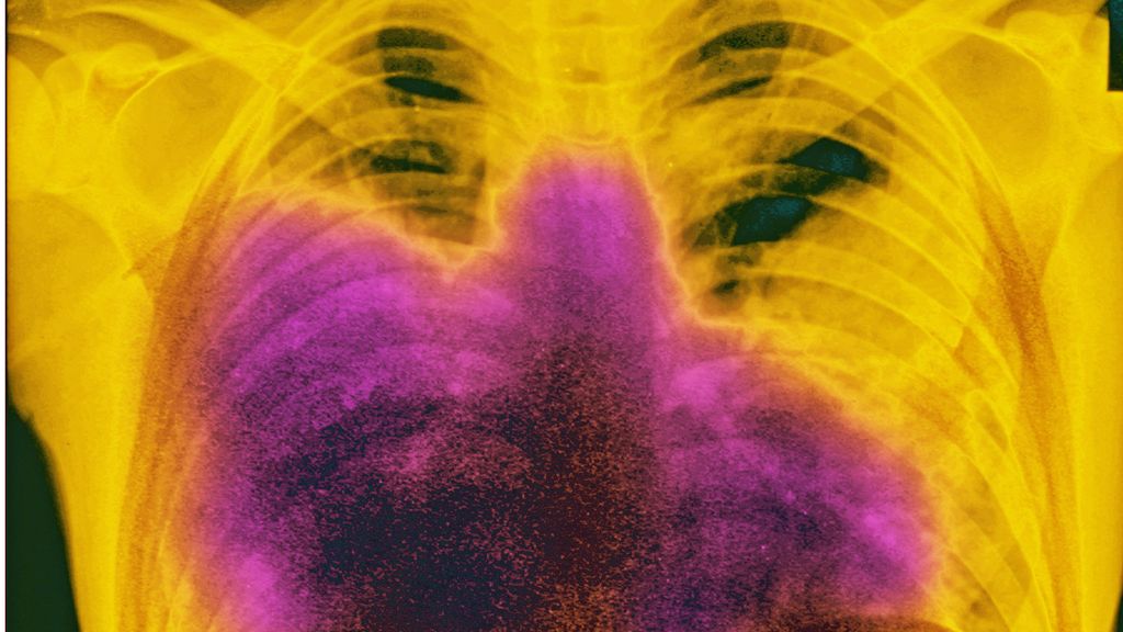 Radiografía de una neumonía bilateral causada por la bacteria Legionella