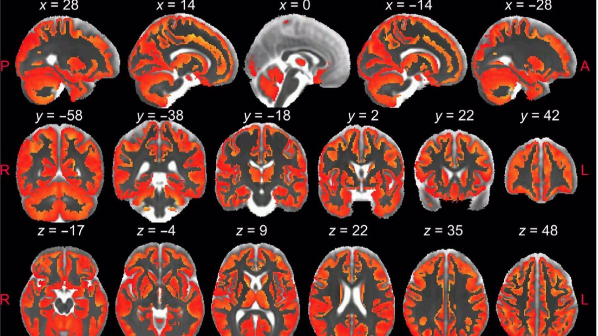 Inflamación cerebro Inflamación cerebro