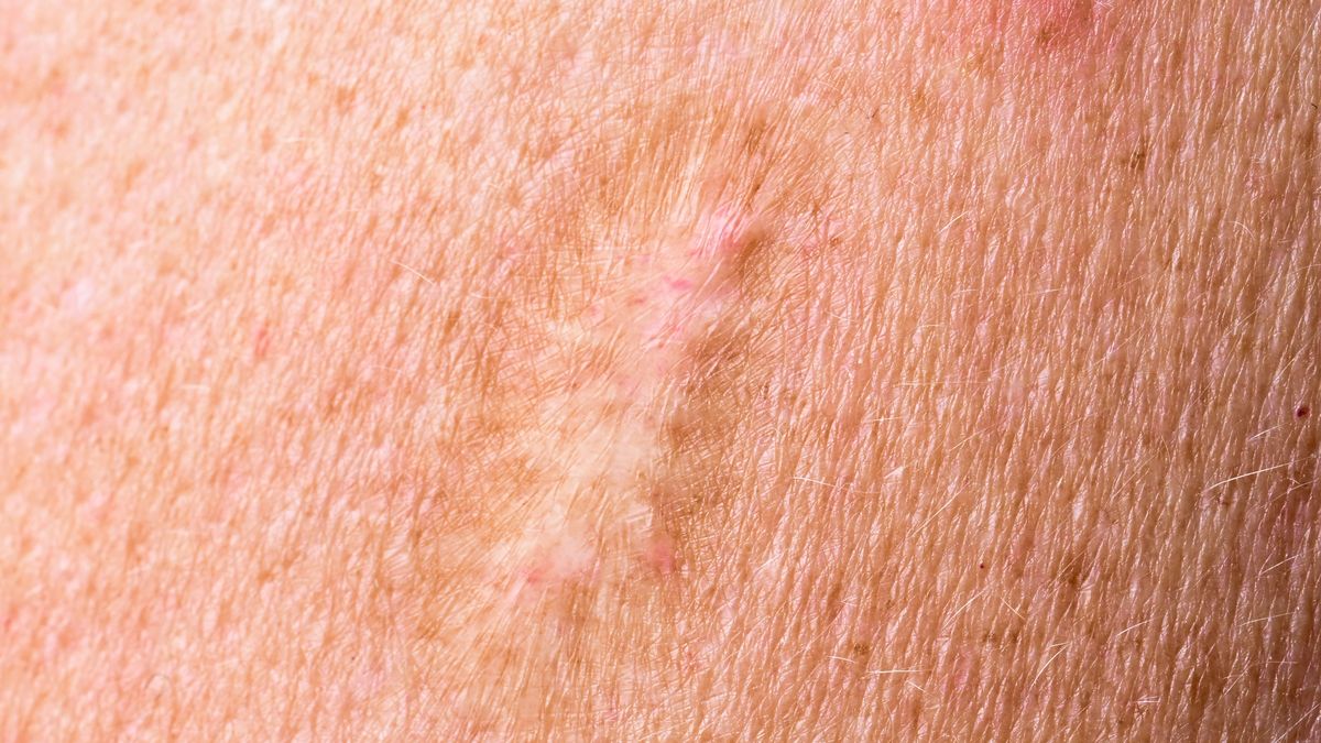 Los vacunados de viruela presentan una cicatriz común